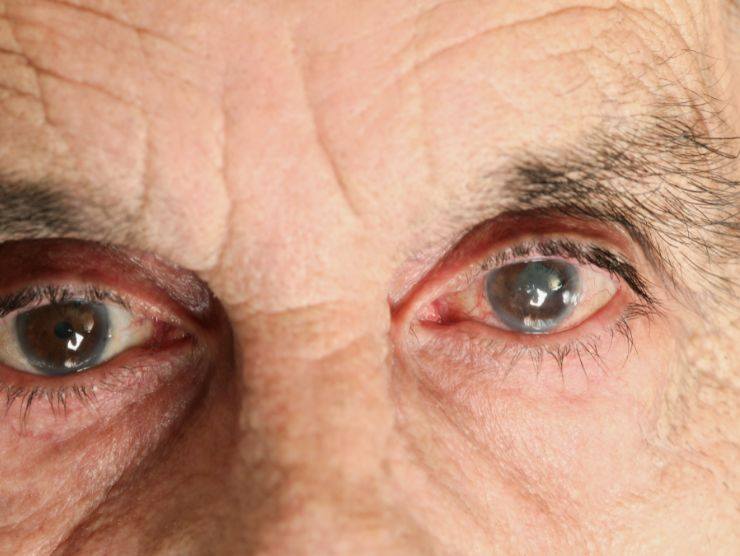 uomo anziano con un glaucoma all'occhio
